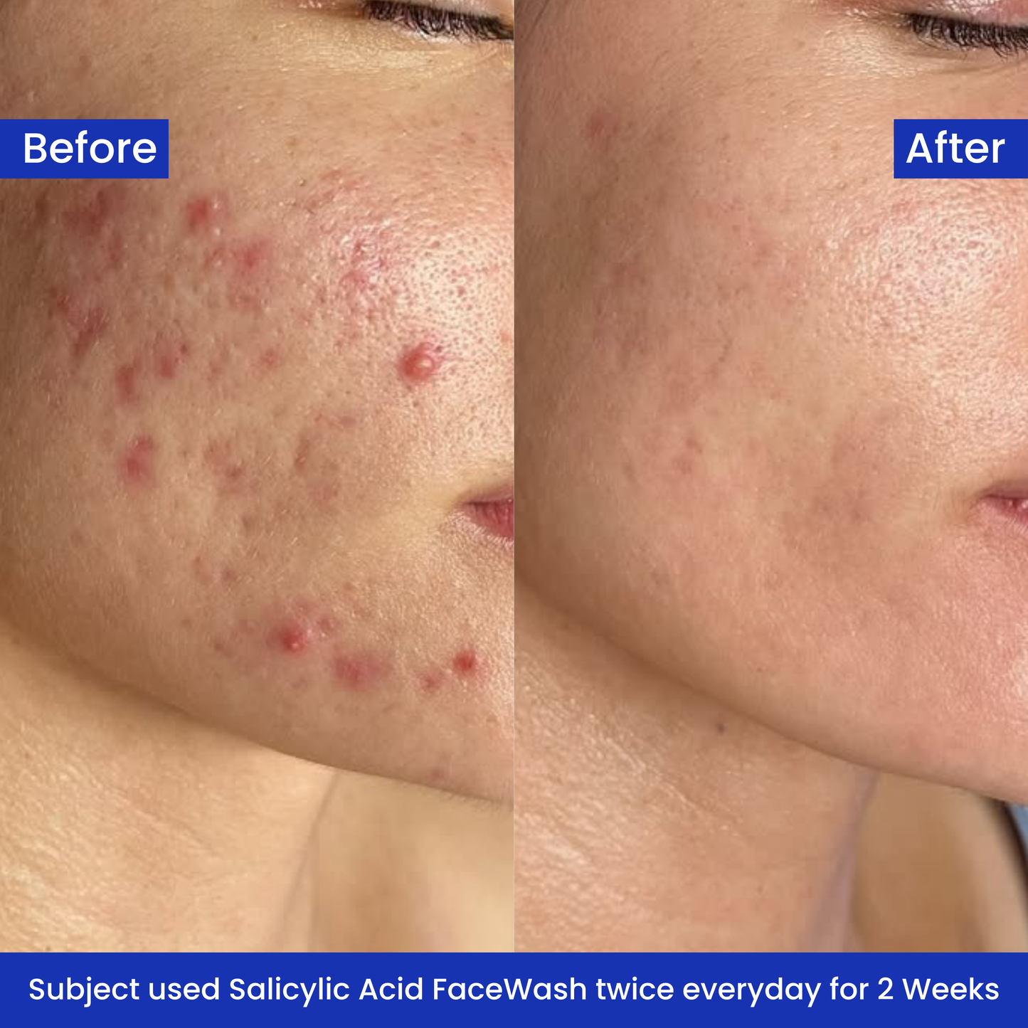 Bodyflame™ - Salicylic Acid Gel Facewash
